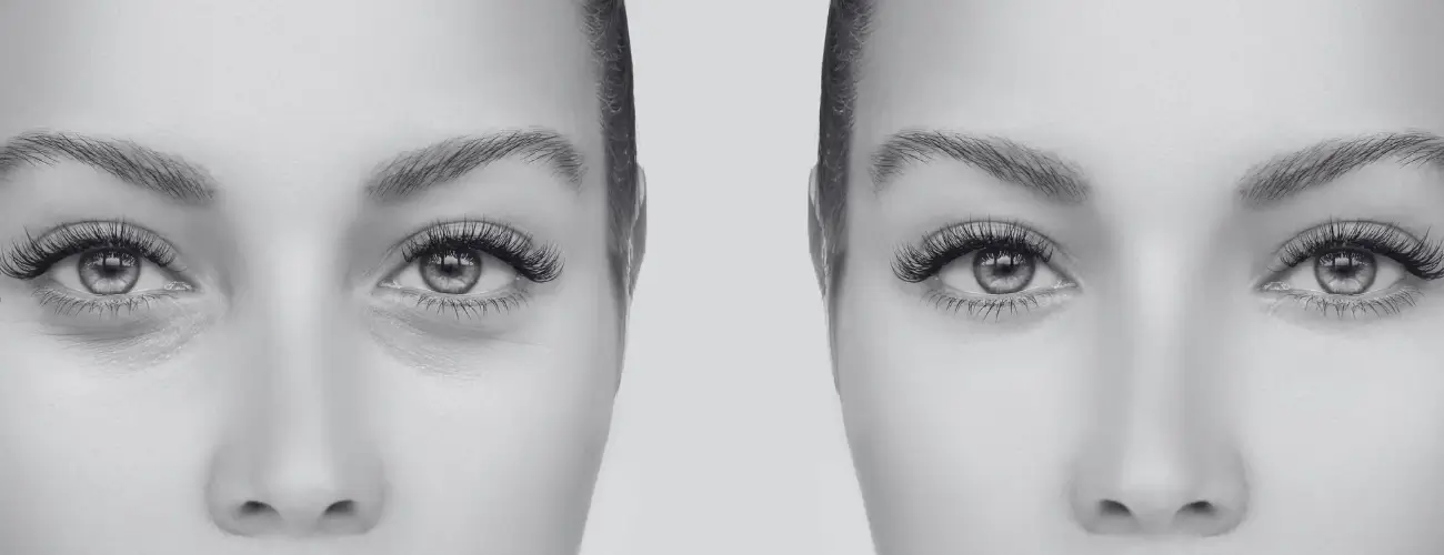 Blefaroplastia superior mujer con antes y después del tratamiento