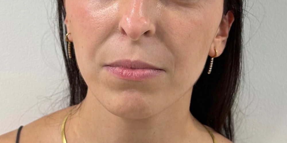 Relleno de surco nasogeneano (2)