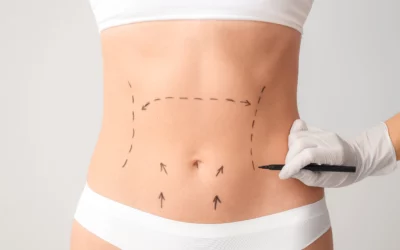 Abdominoplastia: Cómo conseguir un vientre plano y firme para este verano