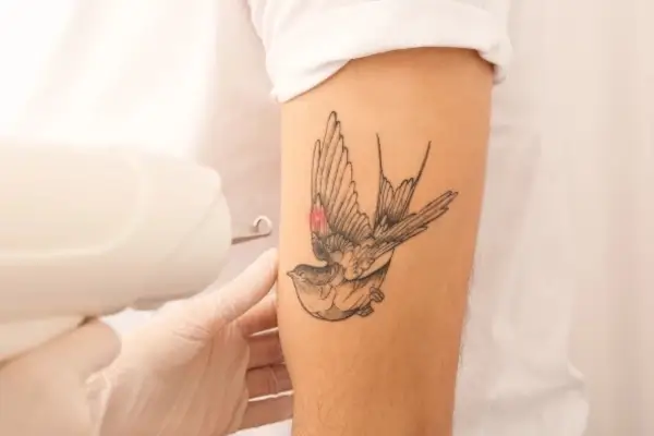 Eliminación de tatuajes en picosegundos