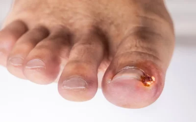 Uñas encarnadas de los pies: tratamiento definitivo en Sabadell sin dolor