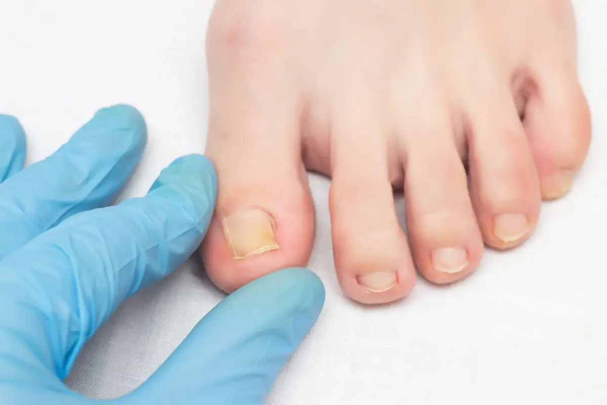 Uñas encarnadas de los pies