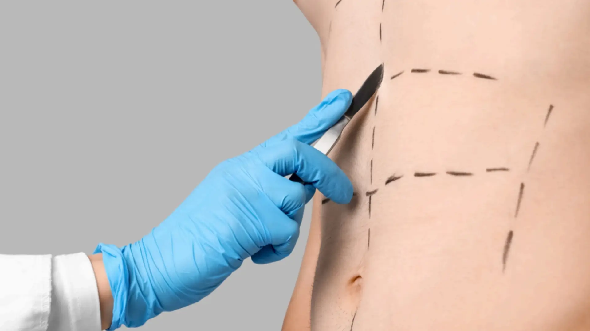 Abdominoplastia (1) Abdominoplastia (1)