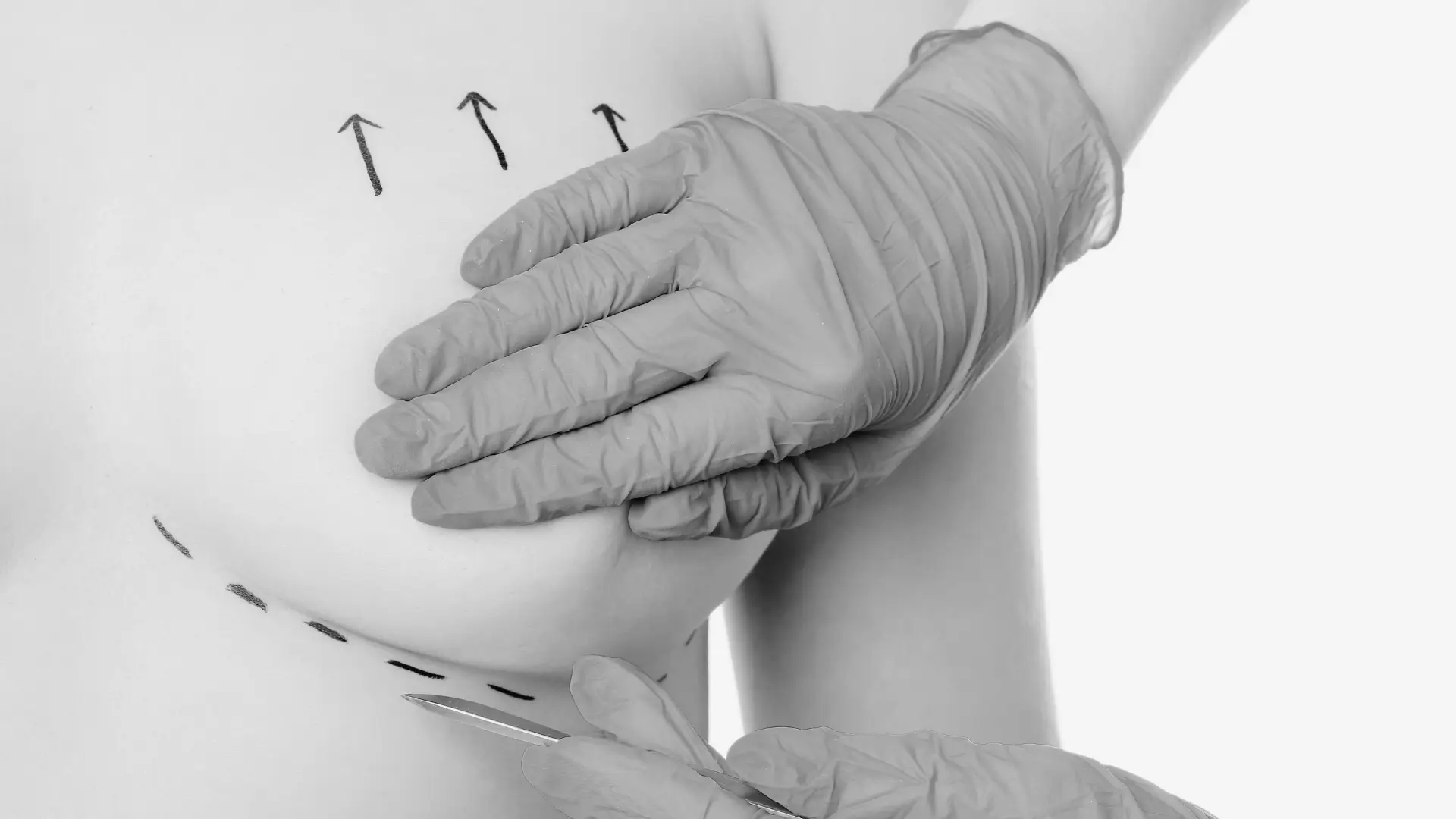 Aumento, reducción y elevación mamaria