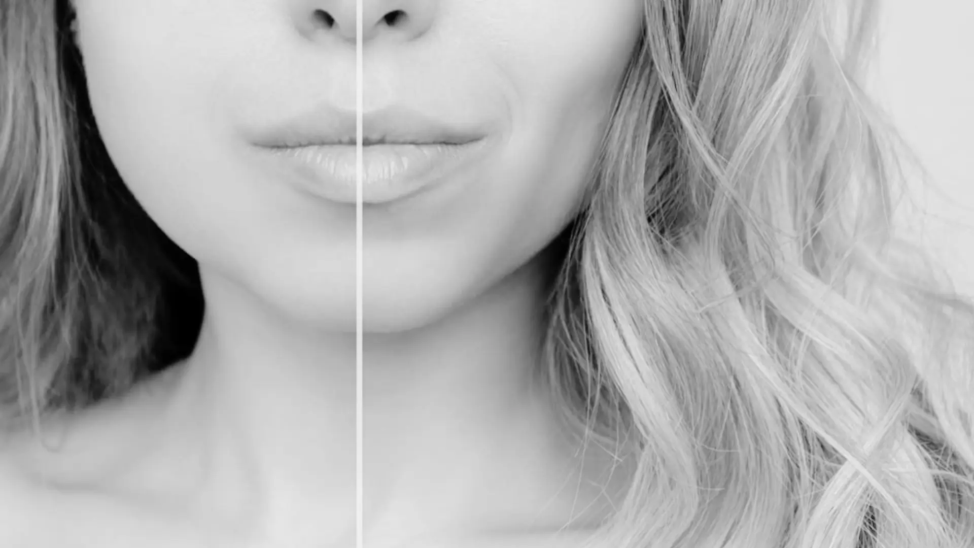 Bichectomía (1) Bichectomía