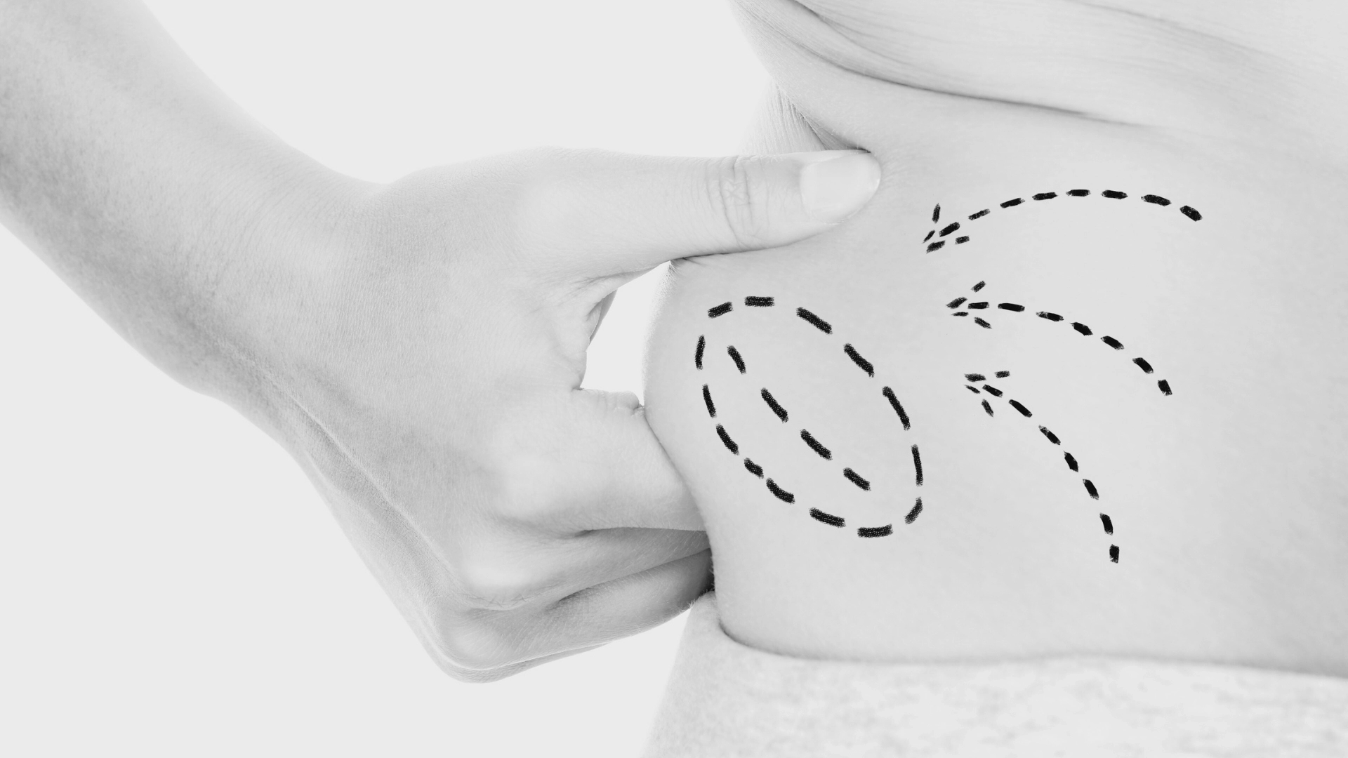 Liposucción Lipotransferencia