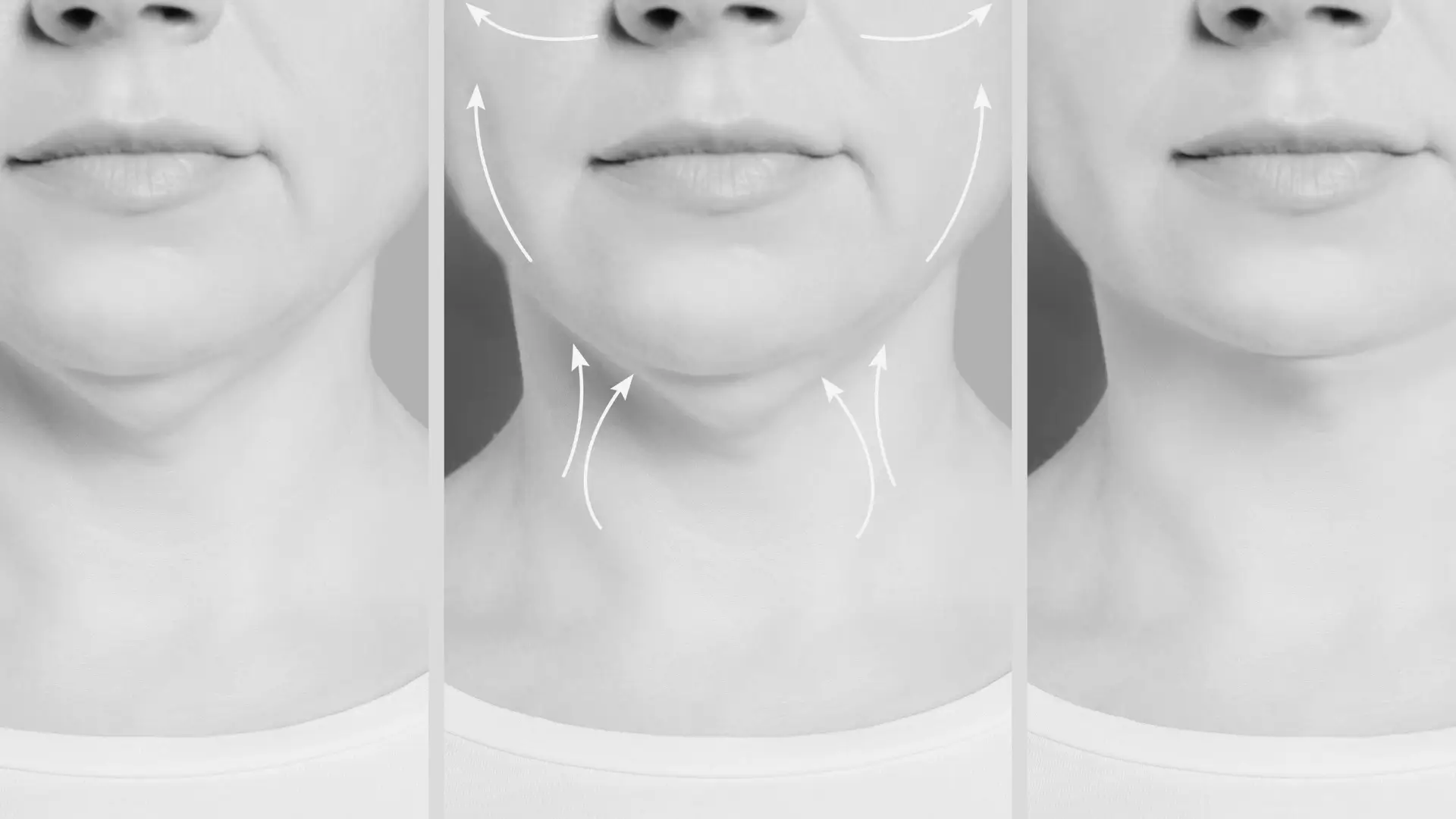 Liposucción de papada Liposucción de papada