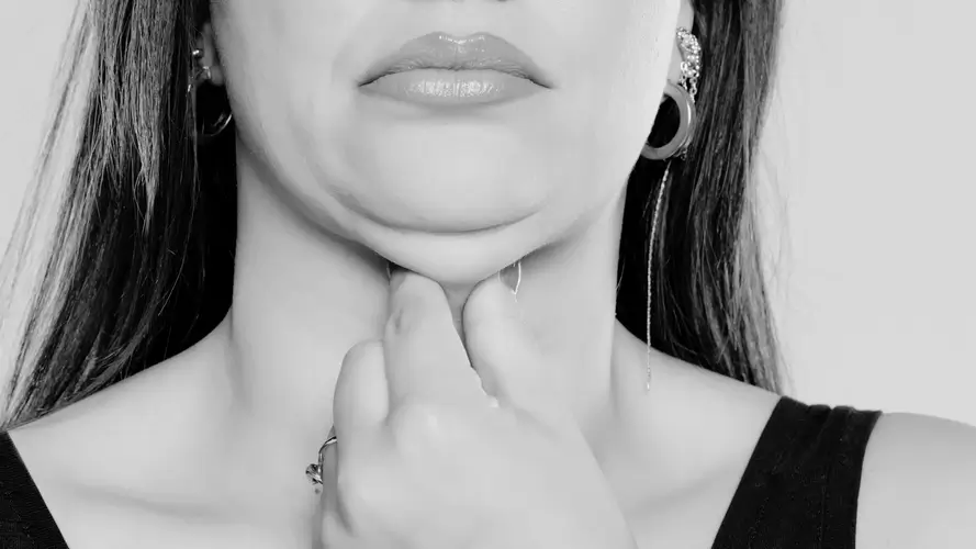 Liposuccion de papada