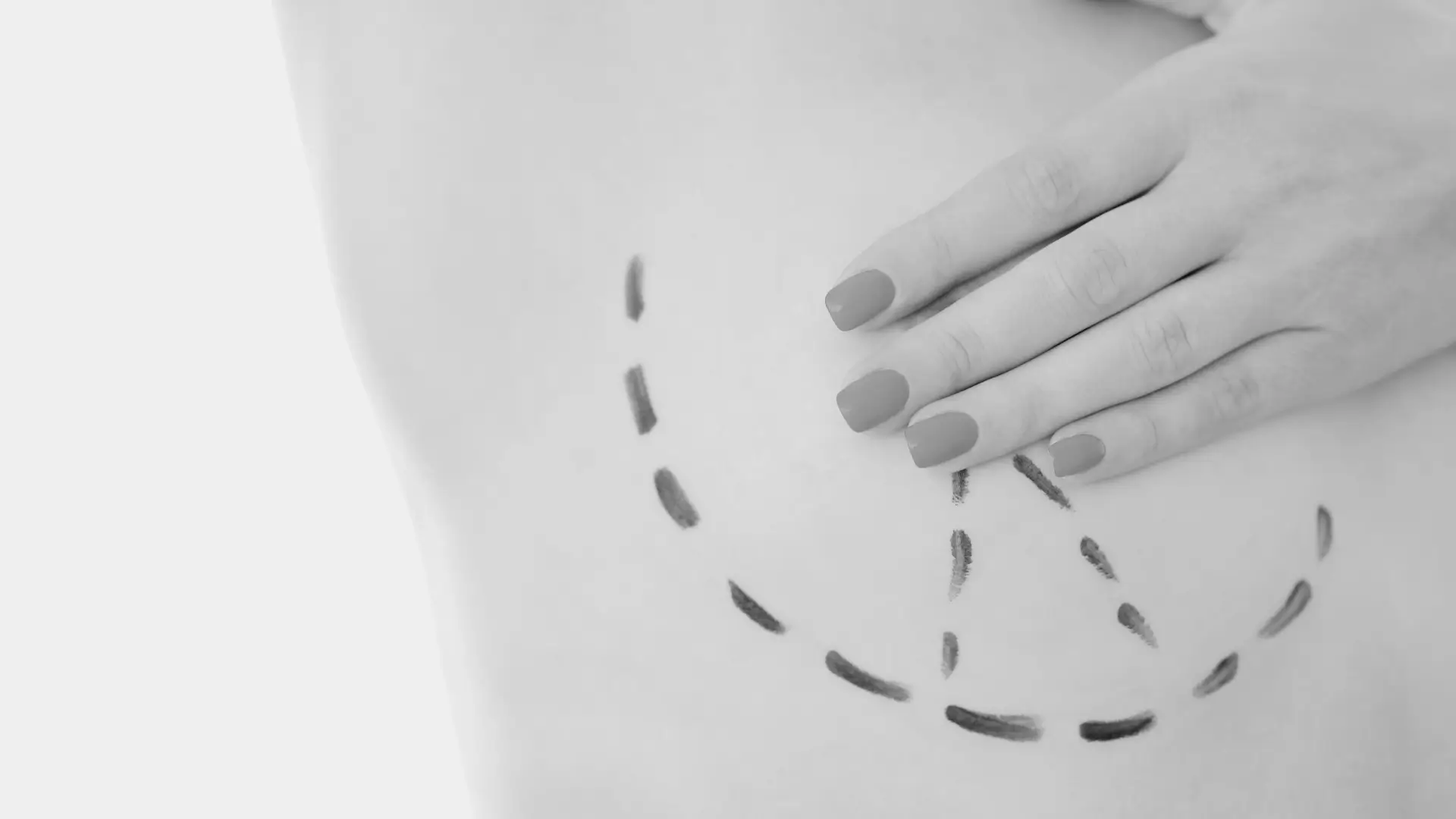 Mastopexia Mastopexia