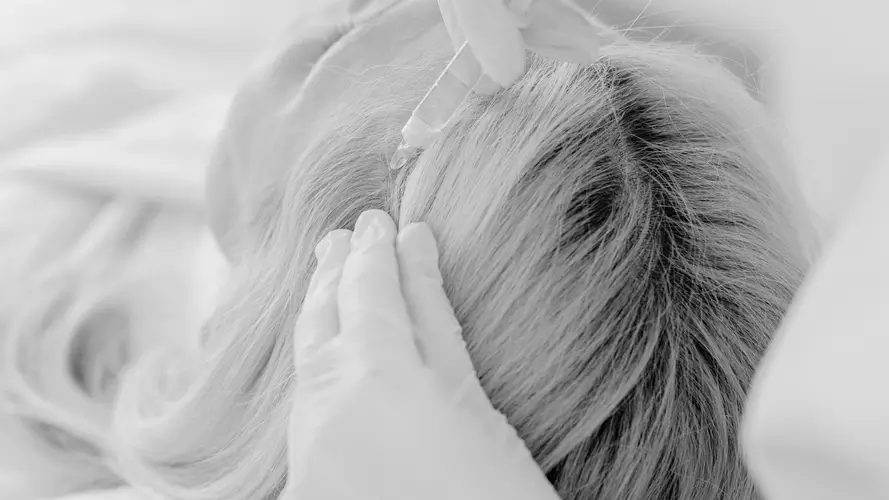 Mesoterapia + coctel angiogénico