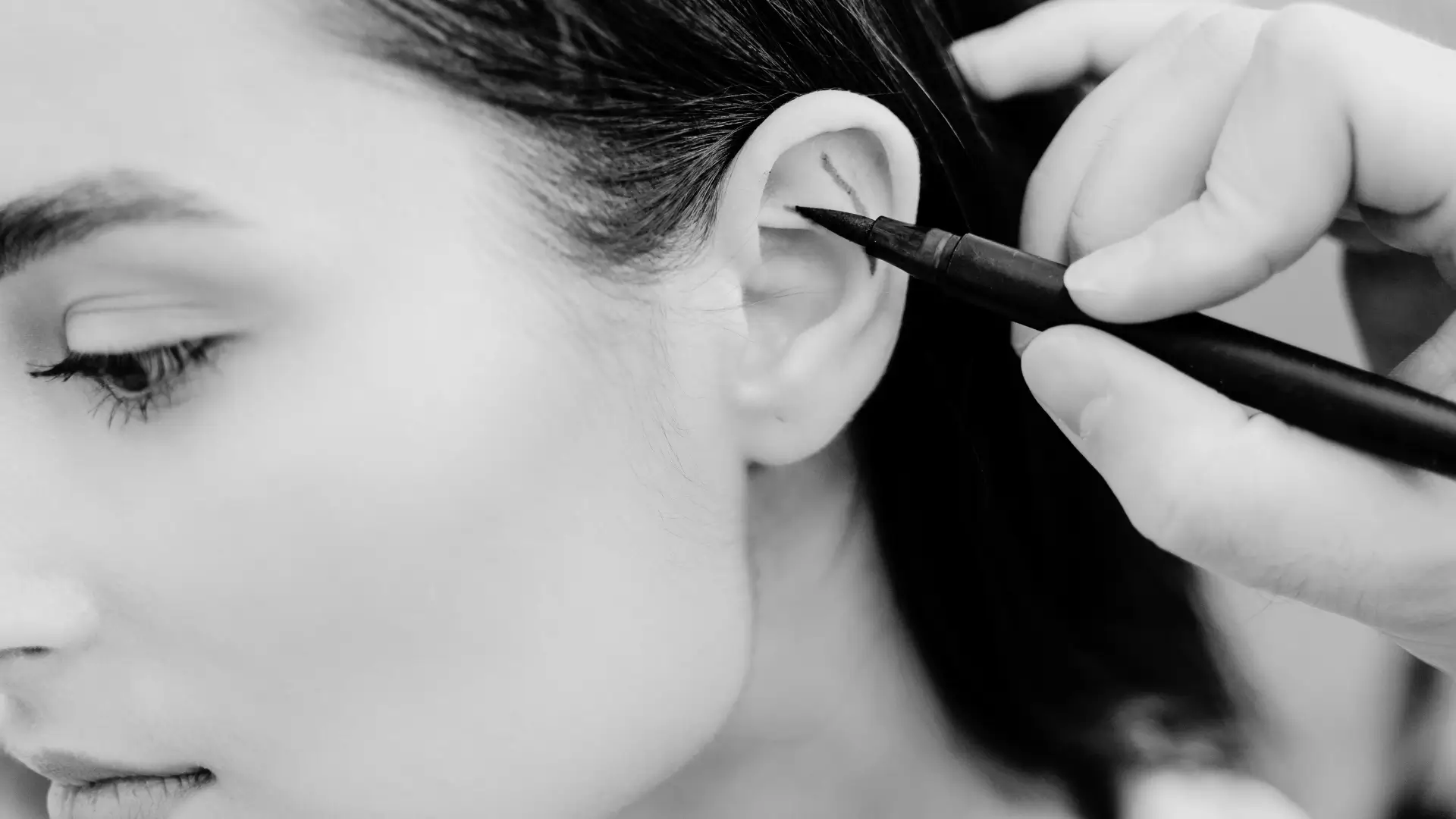 Otoplastia Otoplastia