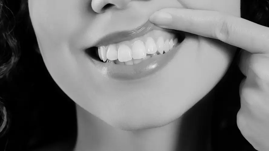 Sonrisa Gingival